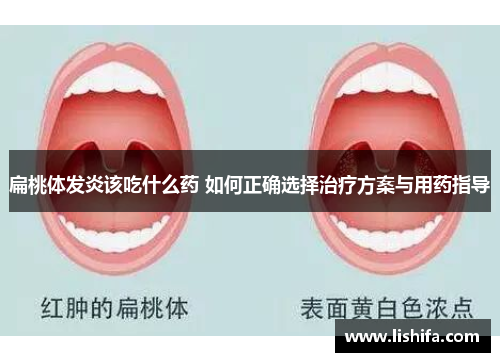 扁桃体发炎该吃什么药 如何正确选择治疗方案与用药指导 扁桃体发炎该吃什么药 如何正确选择治疗方案与用药指导
