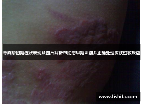 荨麻疹初期症状表现及图片解析帮助您早期识别并正确处理皮肤过敏反应
